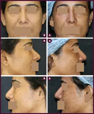 SECONDARY-RHINOPLASTY-1