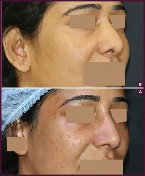 SECONDARY-RHINOPLASTY-2