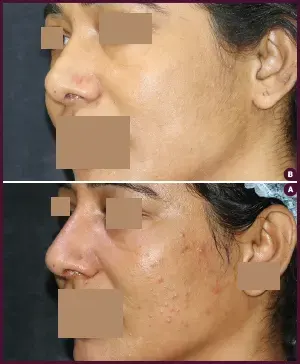 SECONDARY-RHINOPLASTY-3