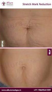 Stretch-Mark-Reduction-Before-and-After-Pictures-in-Mumbai-India