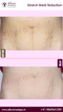 Stretch-Mark-Removal-Before-and-After-Images-in-Mumbai-India
