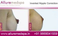 inverted-nipple-correction-before-and-after-gallery-mumbai-india
