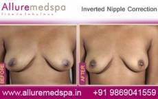 inverted-nipple-correction-before-and-after-photos-mumbai-india