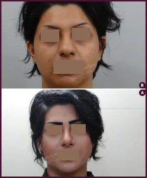 rhinoplasty-COMBINE-1