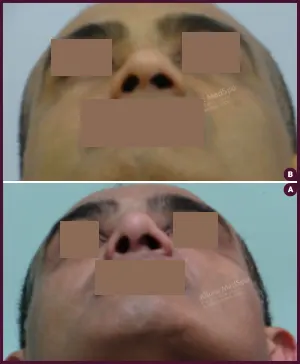 rhinoplasty-COMBINE-10