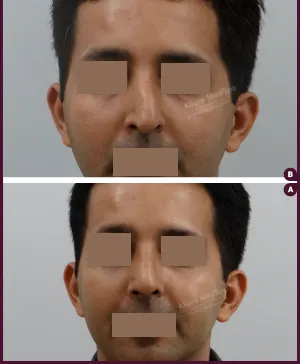 rhinoplasty-COMBINE-11