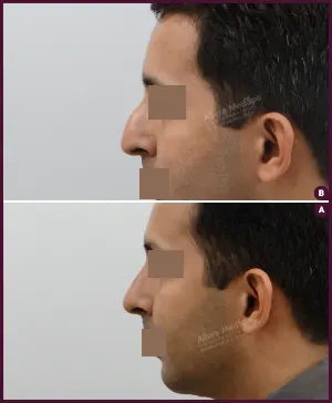 rhinoplasty-COMBINE-12