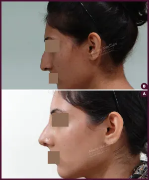 rhinoplasty-COMBINE-13