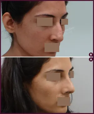 rhinoplasty-COMBINE-14