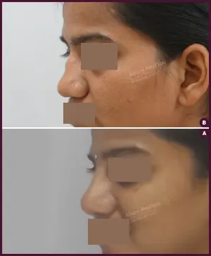 rhinoplasty-COMBINE-15