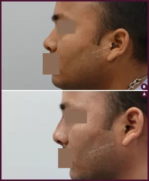 rhinoplasty-COMBINE-16