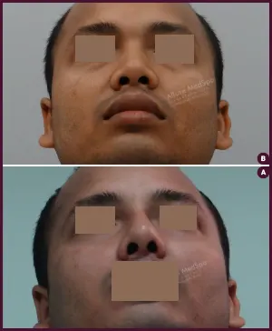 rhinoplasty-COMBINE-17