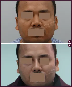 rhinoplasty-COMBINE-18