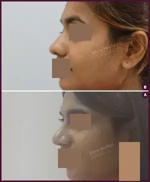 rhinoplasty-COMBINE-19