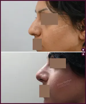 rhinoplasty-COMBINE-2