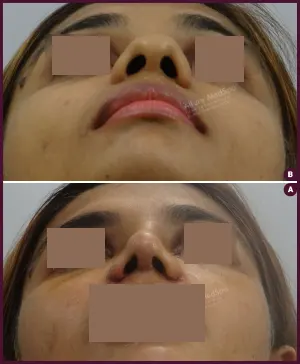 rhinoplasty-COMBINE-20