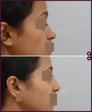 rhinoplasty-COMBINE-21