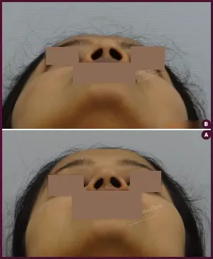 rhinoplasty-COMBINE-22