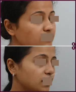rhinoplasty-COMBINE-23