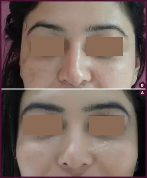 rhinoplasty-COMBINE-24