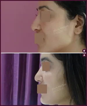 rhinoplasty-COMBINE-25