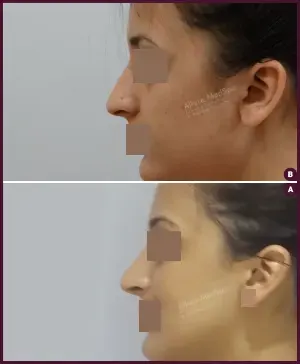 rhinoplasty-COMBINE-26