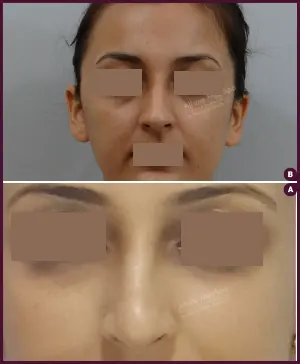rhinoplasty-COMBINE-27