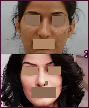 rhinoplasty-COMBINE-28