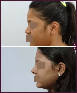 rhinoplasty-COMBINE-3