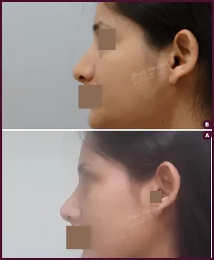 rhinoplasty-COMBINE-30