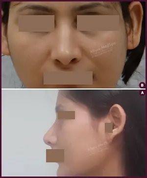 rhinoplasty-COMBINE-31