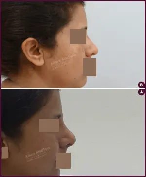 rhinoplasty-COMBINE-32