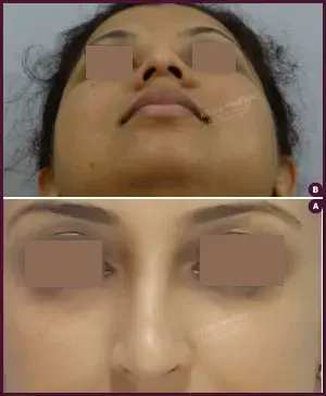 rhinoplasty-COMBINE-33