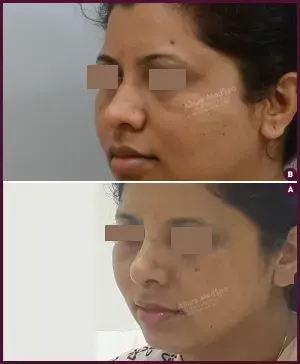 rhinoplasty-COMBINE-34