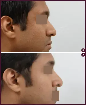 rhinoplasty-COMBINE-35