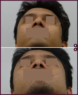 rhinoplasty-COMBINE-36