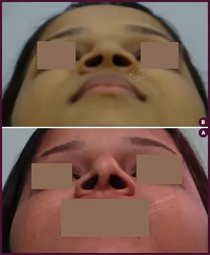 rhinoplasty-COMBINE-4