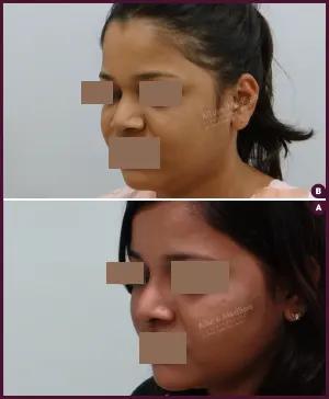 rhinoplasty-COMBINE-6
