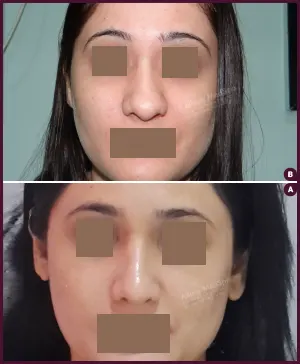 rhinoplasty-COMBINE-7