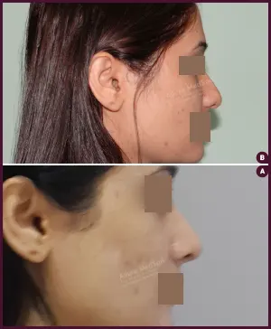 rhinoplasty-COMBINE-8
