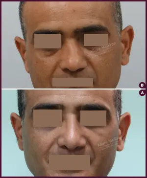 rhinoplasty-COMBINE-9