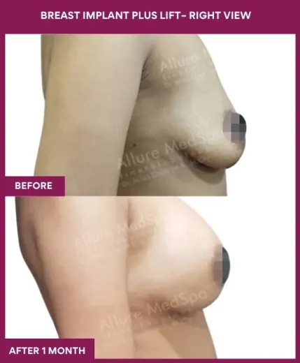 1 BREAST IMPLANT PLUS LIFT– RIGHT VIEW_3