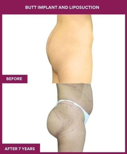 1 BUTT IMPLANT AND LIPOSUCTION (2) in Mumbai, India