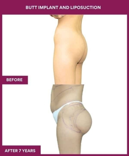 1 BUTT IMPLANT AND LIPOSUCTION (2) in Mumbai, India