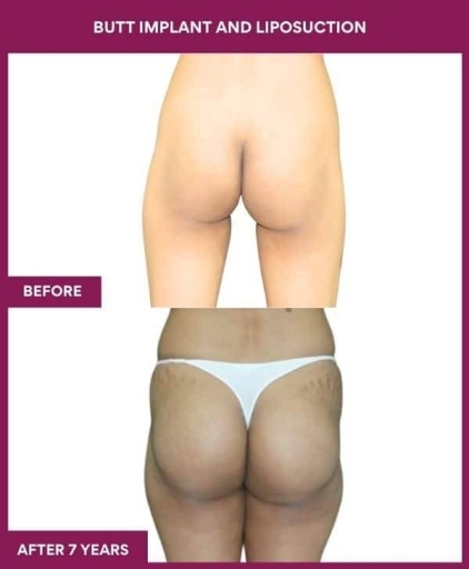 1 BUTT IMPLANT AND LIPOSUCTION (2) in Mumbai, India