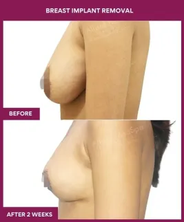 1- Breast implant removal_3_ (3)