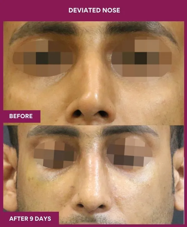 1 DEVIATED NOSE_21_ (1)