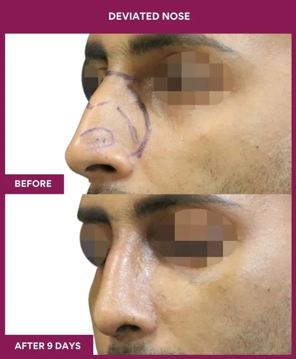 1 DEVIATED NOSE_21_ (2)