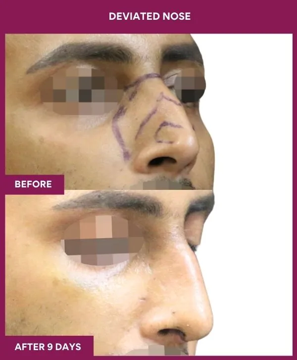 1 DEVIATED NOSE_21_ (3)