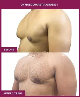 1- GYNAECOMASTIA GRADE 1 (2)_